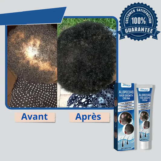 Alopécie Créme GB