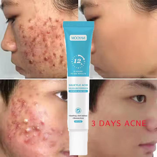 .  🌿 Gel Anti-Acné à l’Acide Salicylique – Résultats visibles en 5 jours!