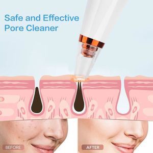 Extracteur de Points Noirs Professionnel